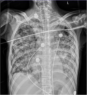 Disseminated tuberculosis in a child during the COVID-19 pandemic: a case report and literature review